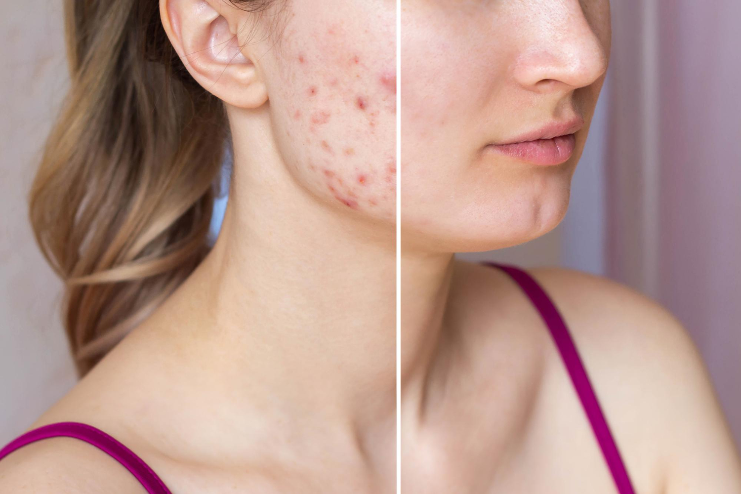 Acne Treatment