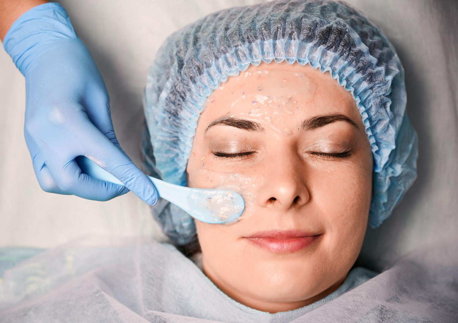 chemical peels